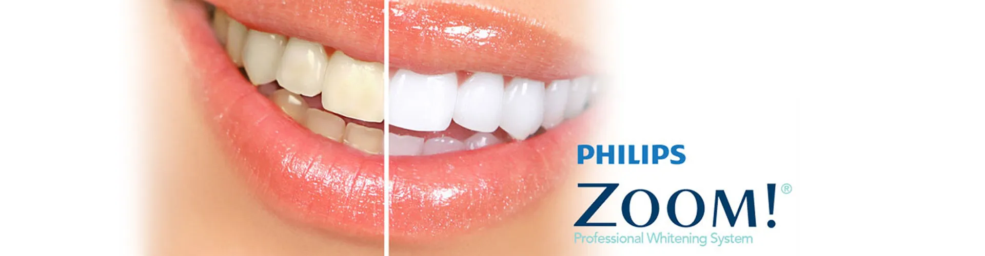 29755 in office teeth whitening