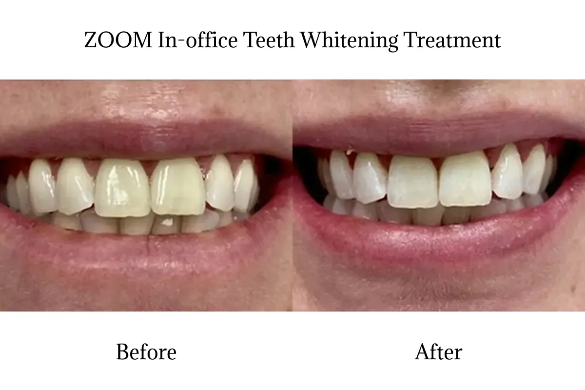 29755 teeth whitening process