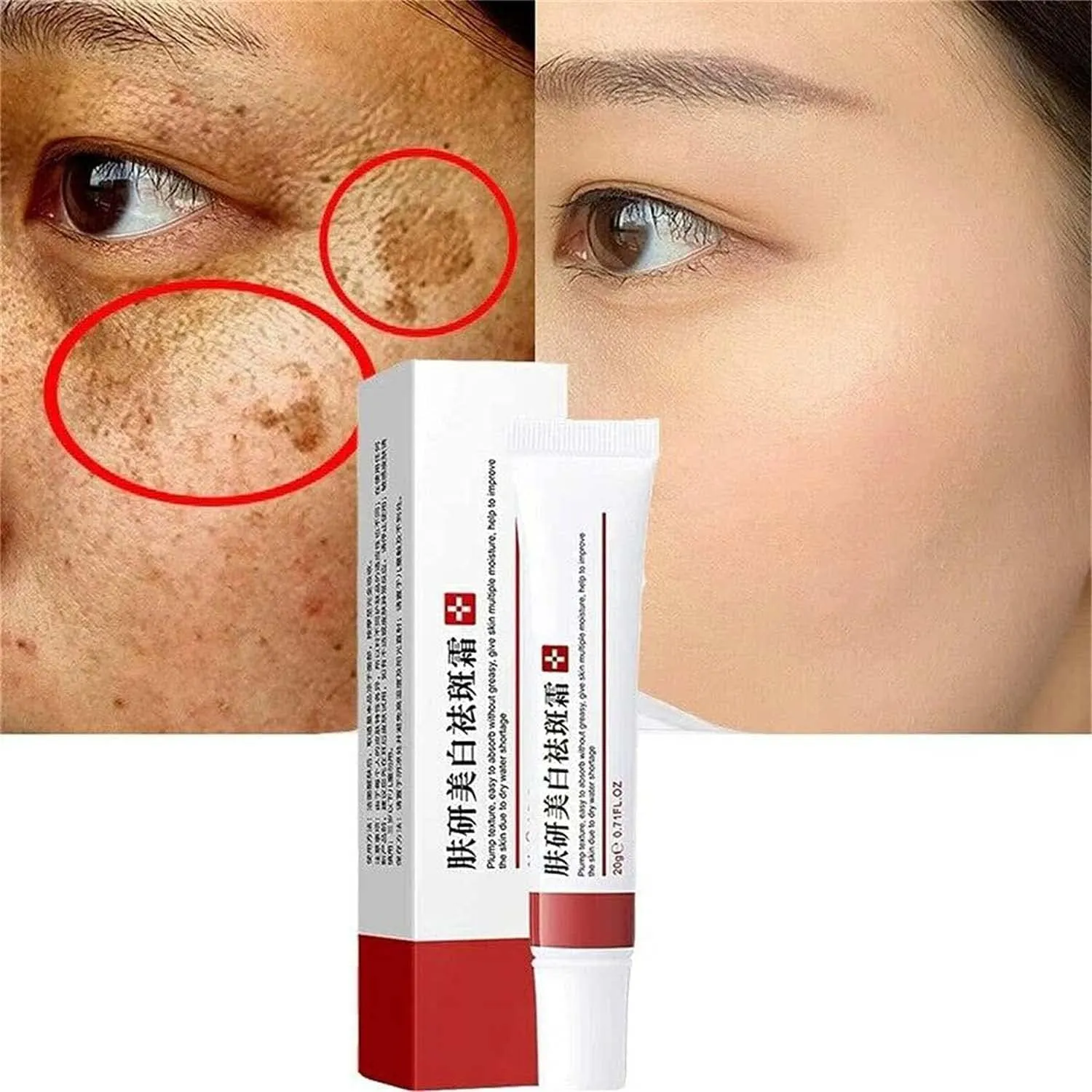 29756 hyperpigmentation treatment