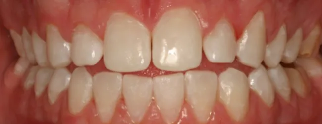 29761 whitening strips gels