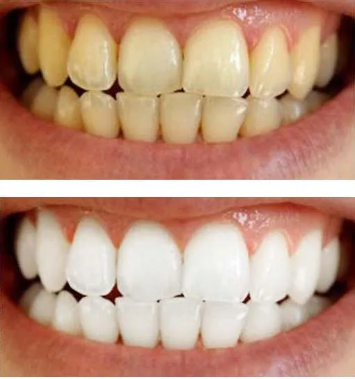 29762 teeth whitening comparison
