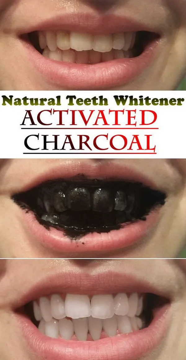 29766 teeth whitening smile