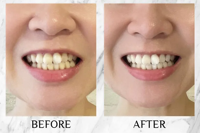 29770 teeth sensitivity tips