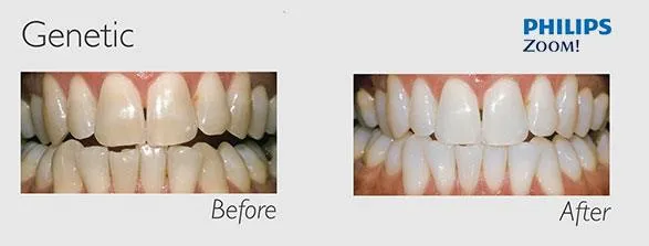 29777 tooth color change