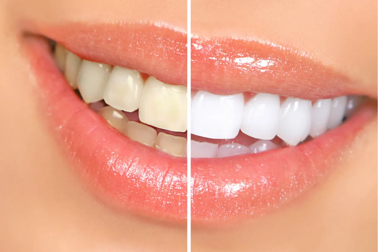 /img/29781-teeth-whitening-comparison.webp