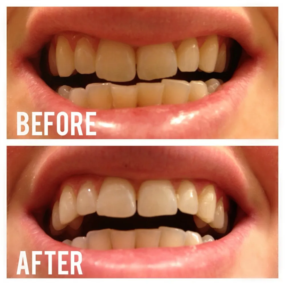 29783 charcoal teeth whitening before after