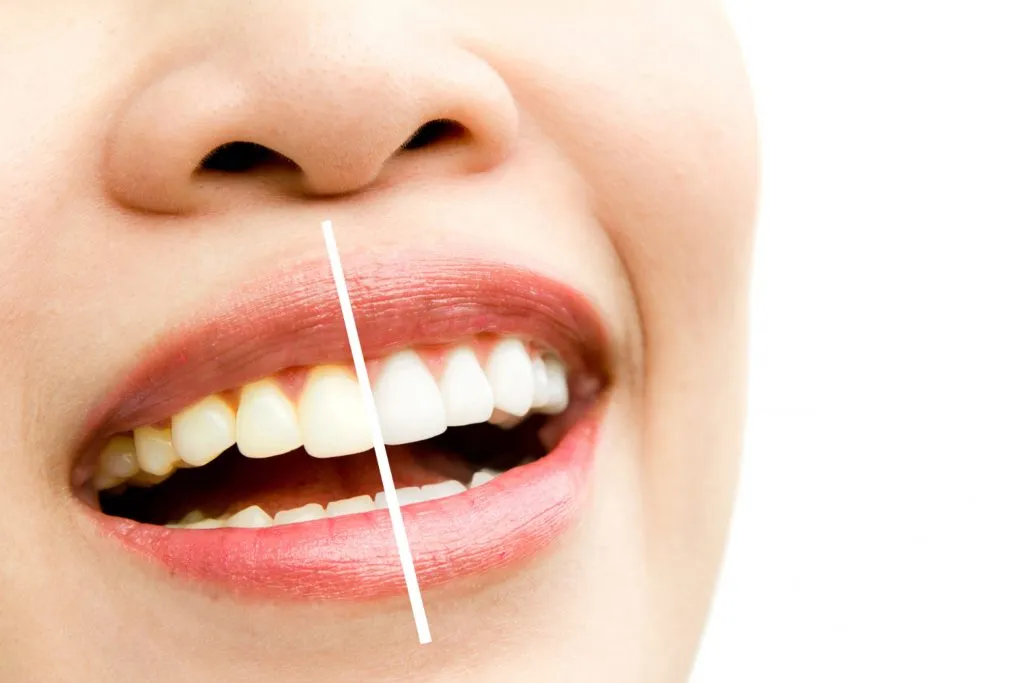 29785 teeth whitening lafayette la image1