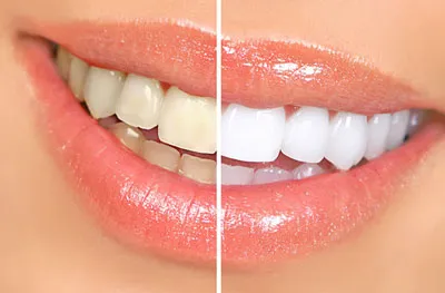 29785 teeth whitening lafayette la image2
