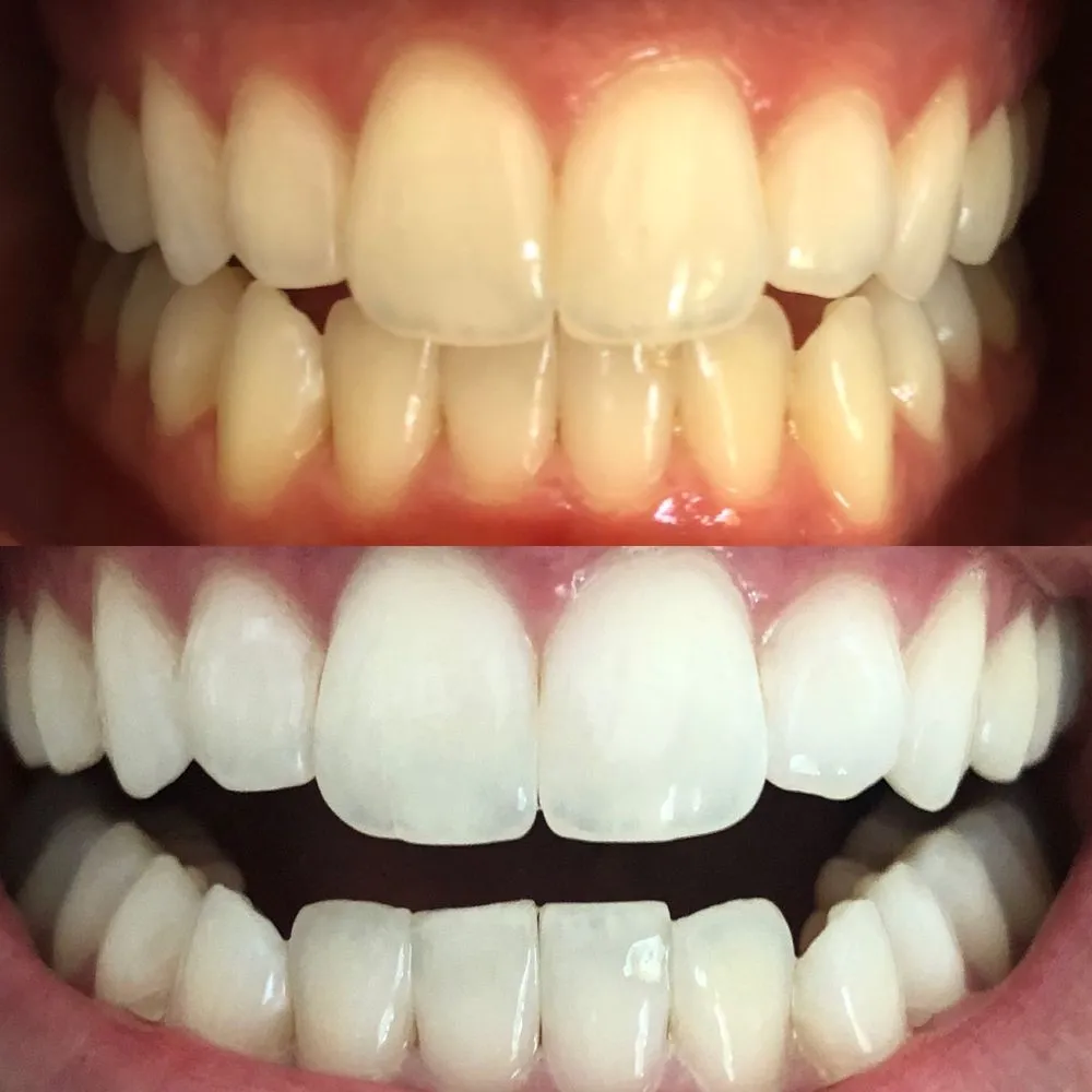 29785 teeth whitening lafayette la image5