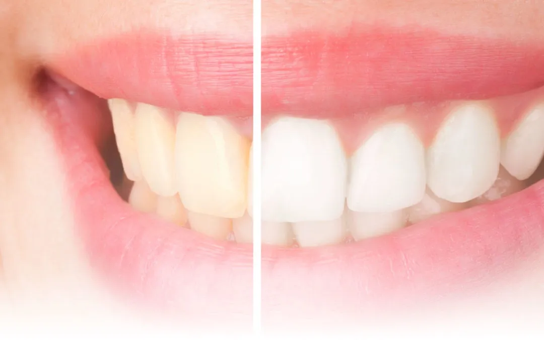 /img/29785-teeth-whitening-lafayette-la-image7.webp