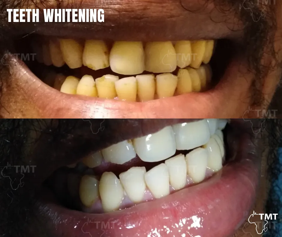 29787 teeth whitening tunisia before after