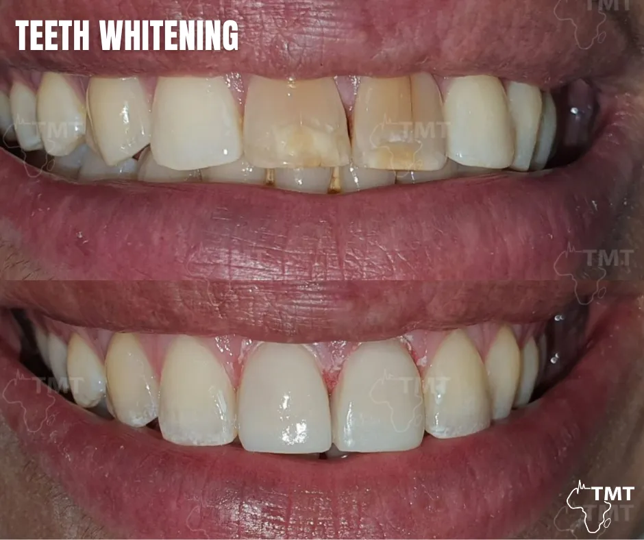 /img/29787-teeth-whitening-tunisia-checkup.webp