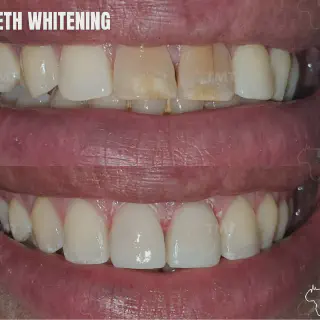 /img/29787-teeth-whitening-tunisia-checkup.webp