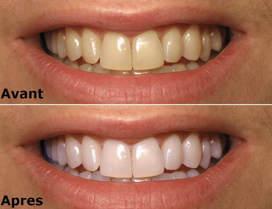 29787 teeth whitening tunisia foods