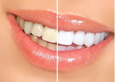 29787 teeth whitening tunisia smile