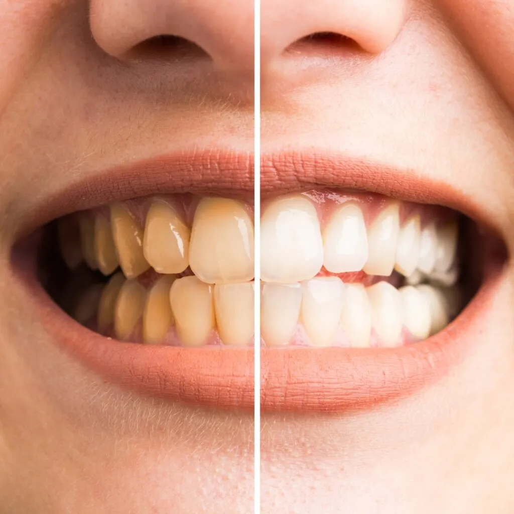 29789 teeth whitening queens ny 5