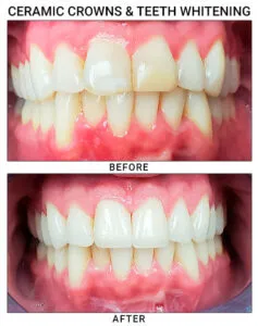 29789 teeth whitening queens ny 7