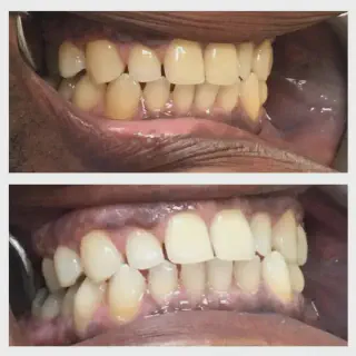 /img/29789-teeth-whitening-queens-ny-8.webp