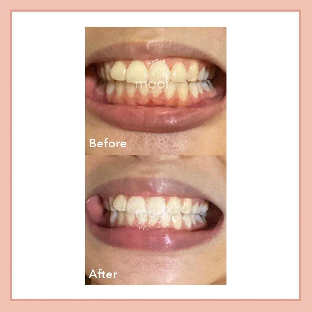 29795 professional teeth whitening