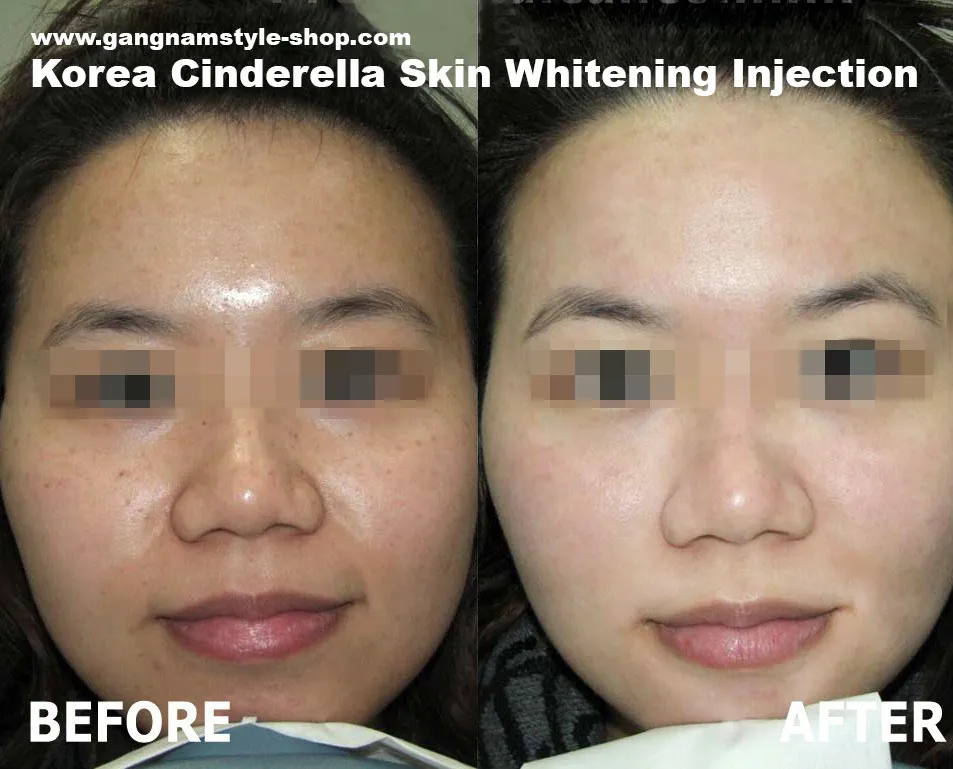 29799 whitening injection procedure
