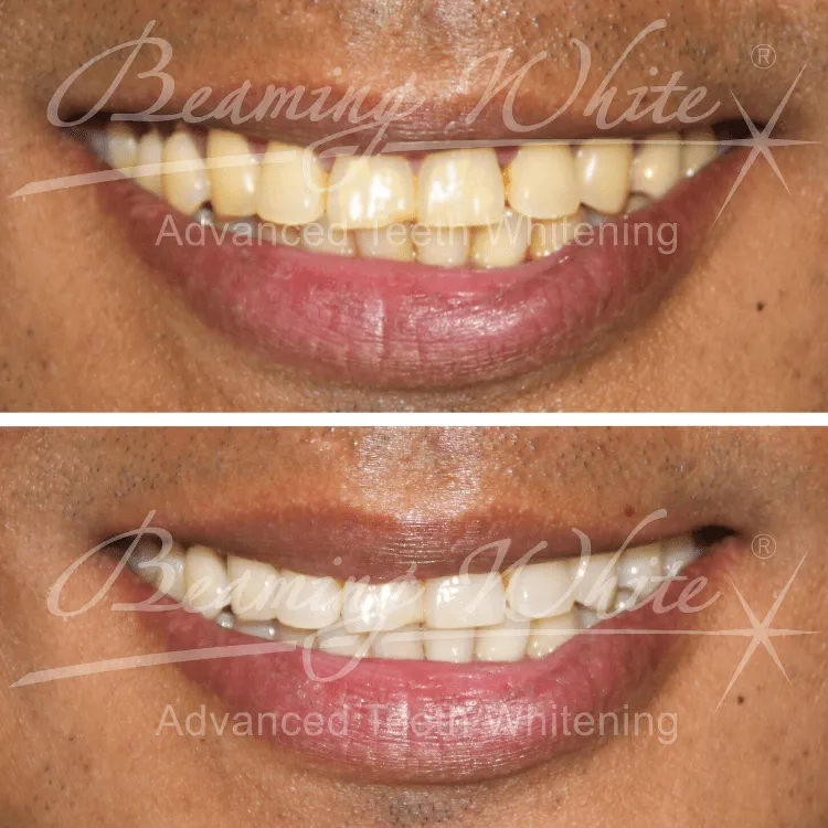 29803 aftercare teeth whitening