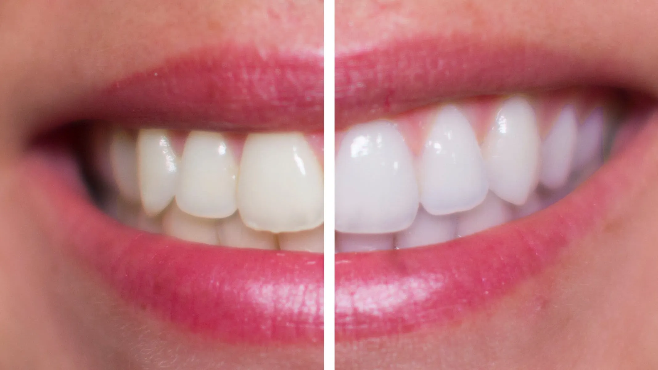 29810 home teeth whitening