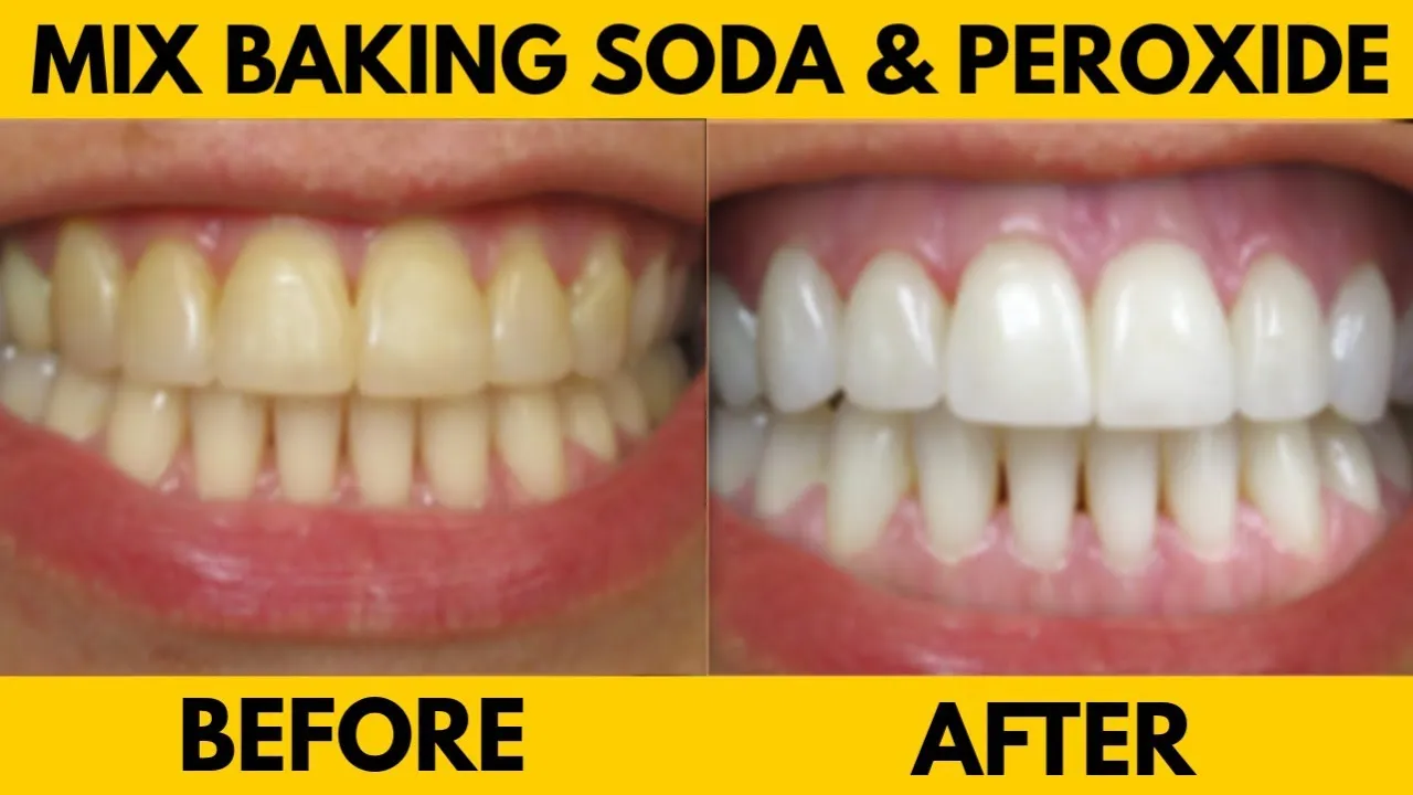 29810 professional teeth whitening