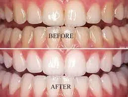 29814 teeth whitening care