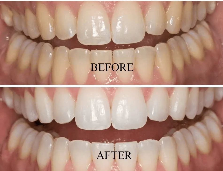29814 teeth whitening procedure