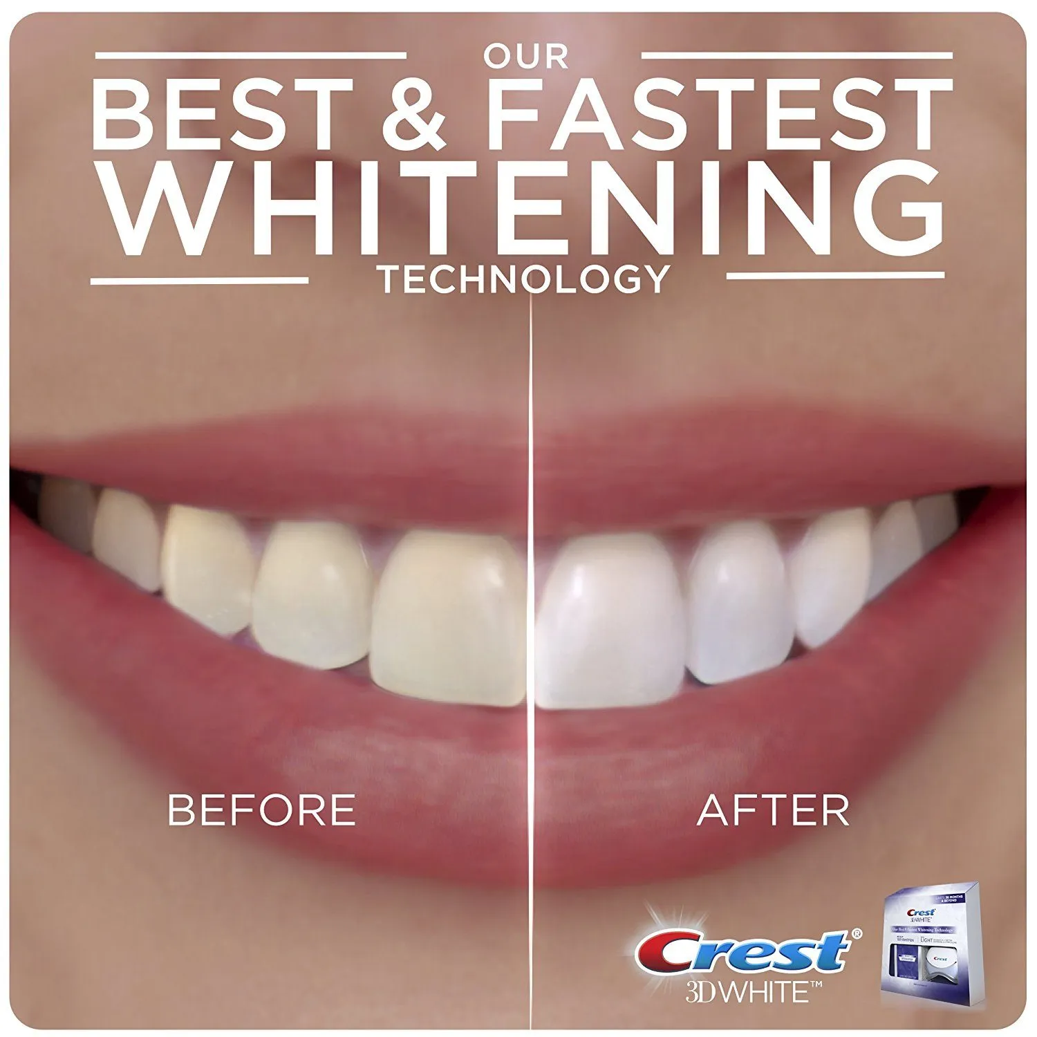 29815 whitening strips application