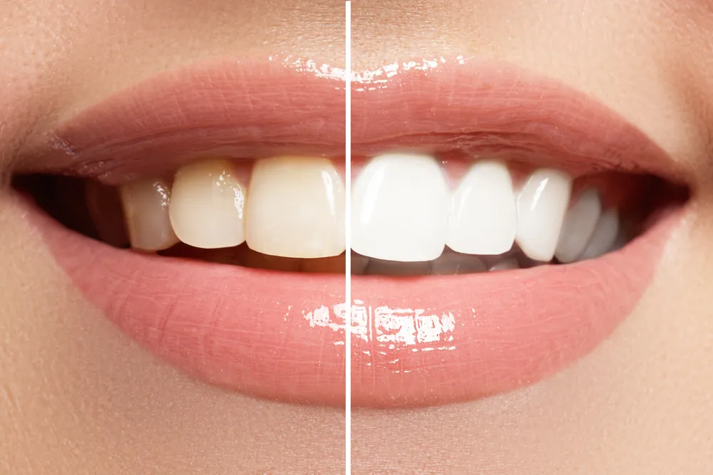 29819 at home teeth whitening