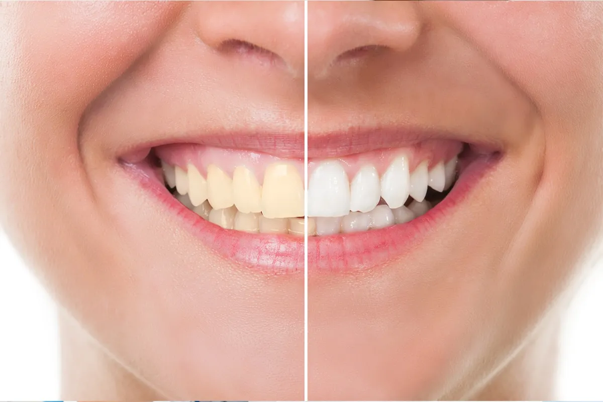 29819 in office teeth whitening