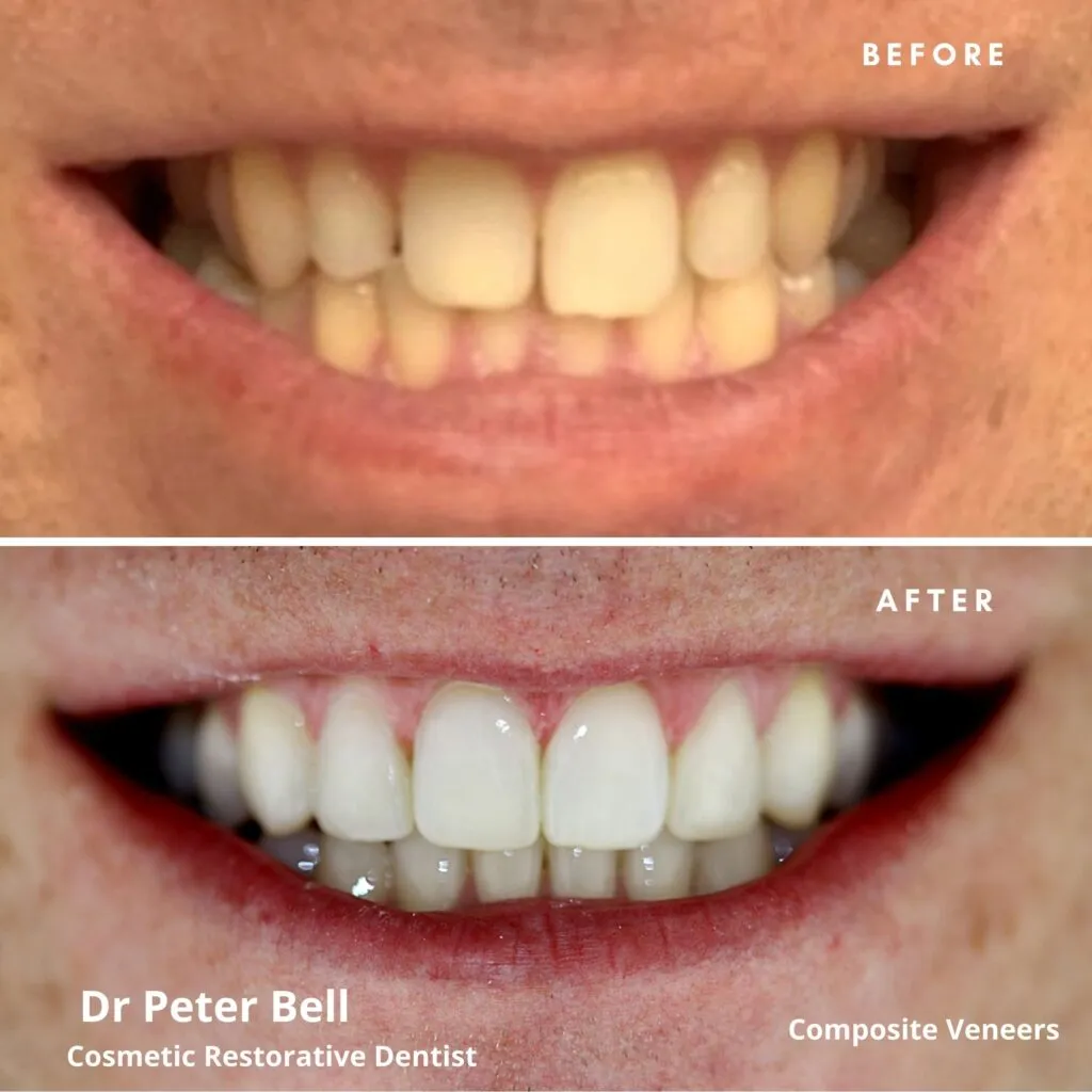 29819 teeth whitening comparison