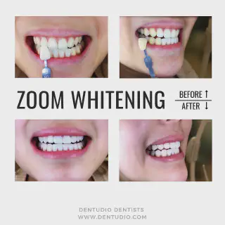 /img/29821-zoom-whitening-results.webp