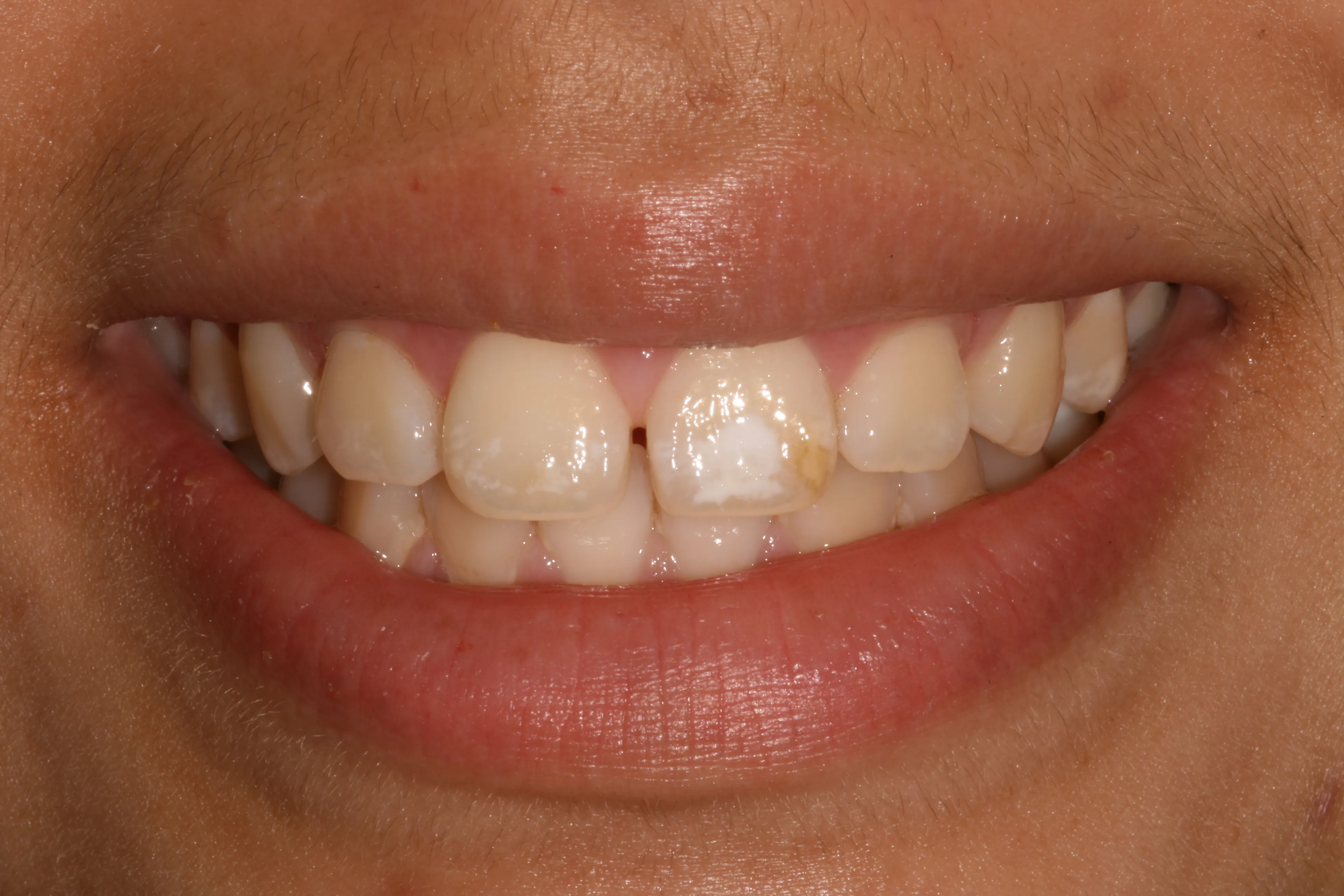 /img/29828-teeth-sensitivity.webp