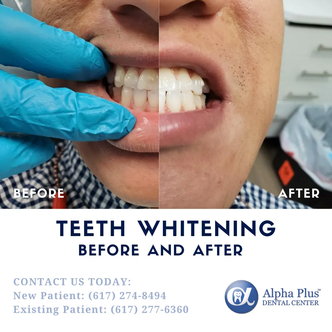 29833 at home whitening kits