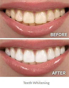 29833 professional teeth whitening
