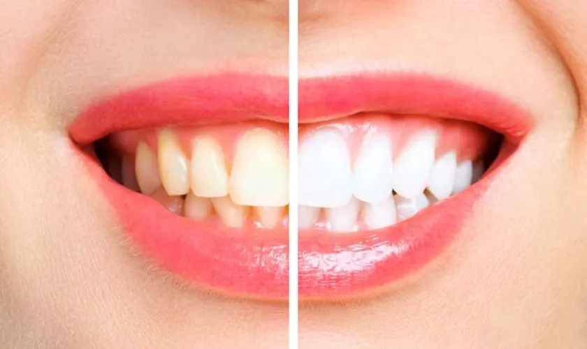 29838 teeth whitening options fargo
