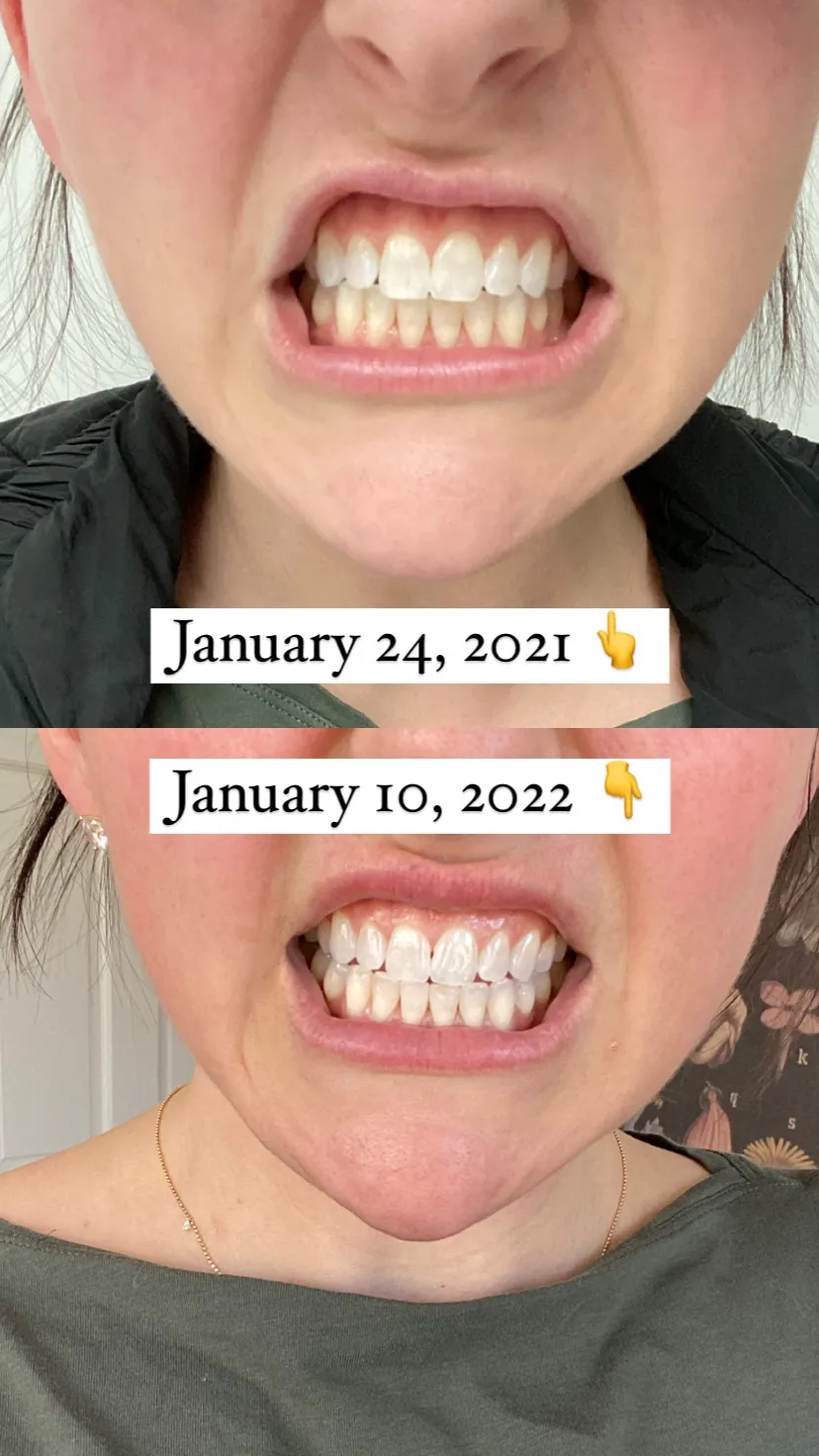 29839 alternatives to whitening strips