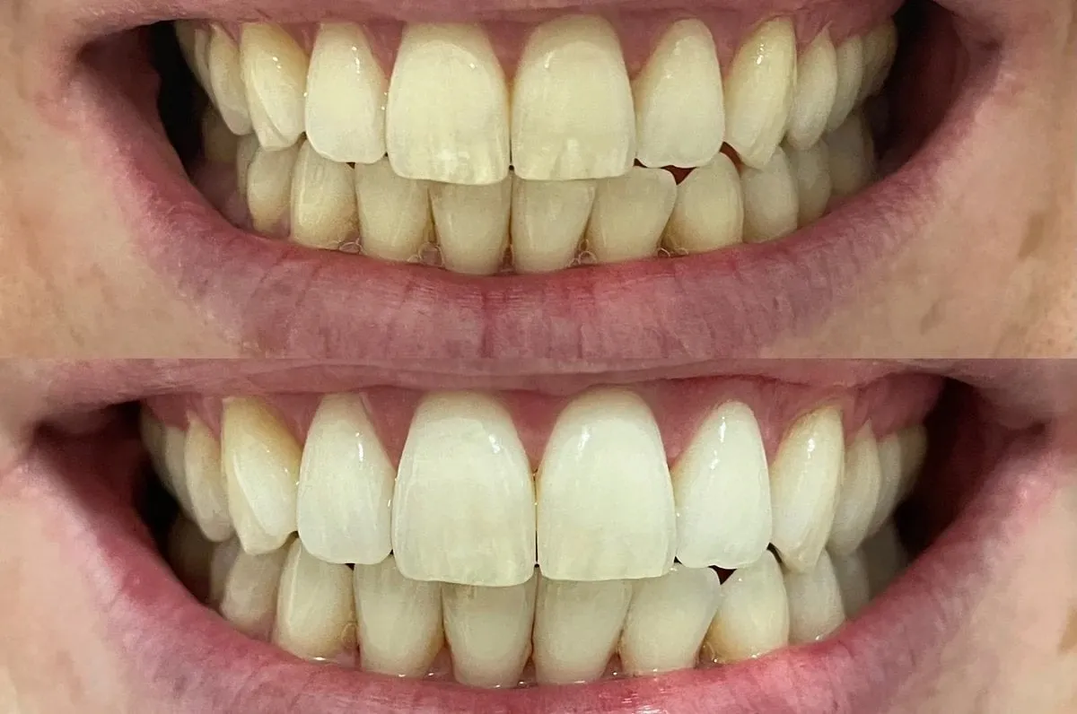 29839 teeth whitening comparison