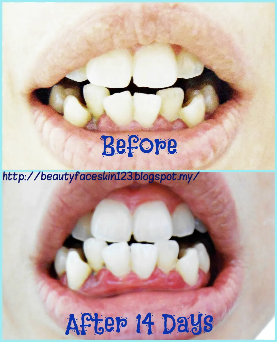 29839 user review teeth whitening