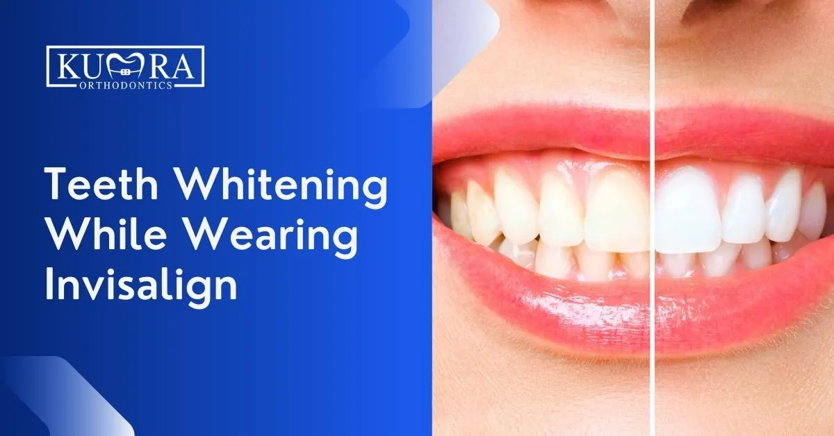 29842 invisalign alignment