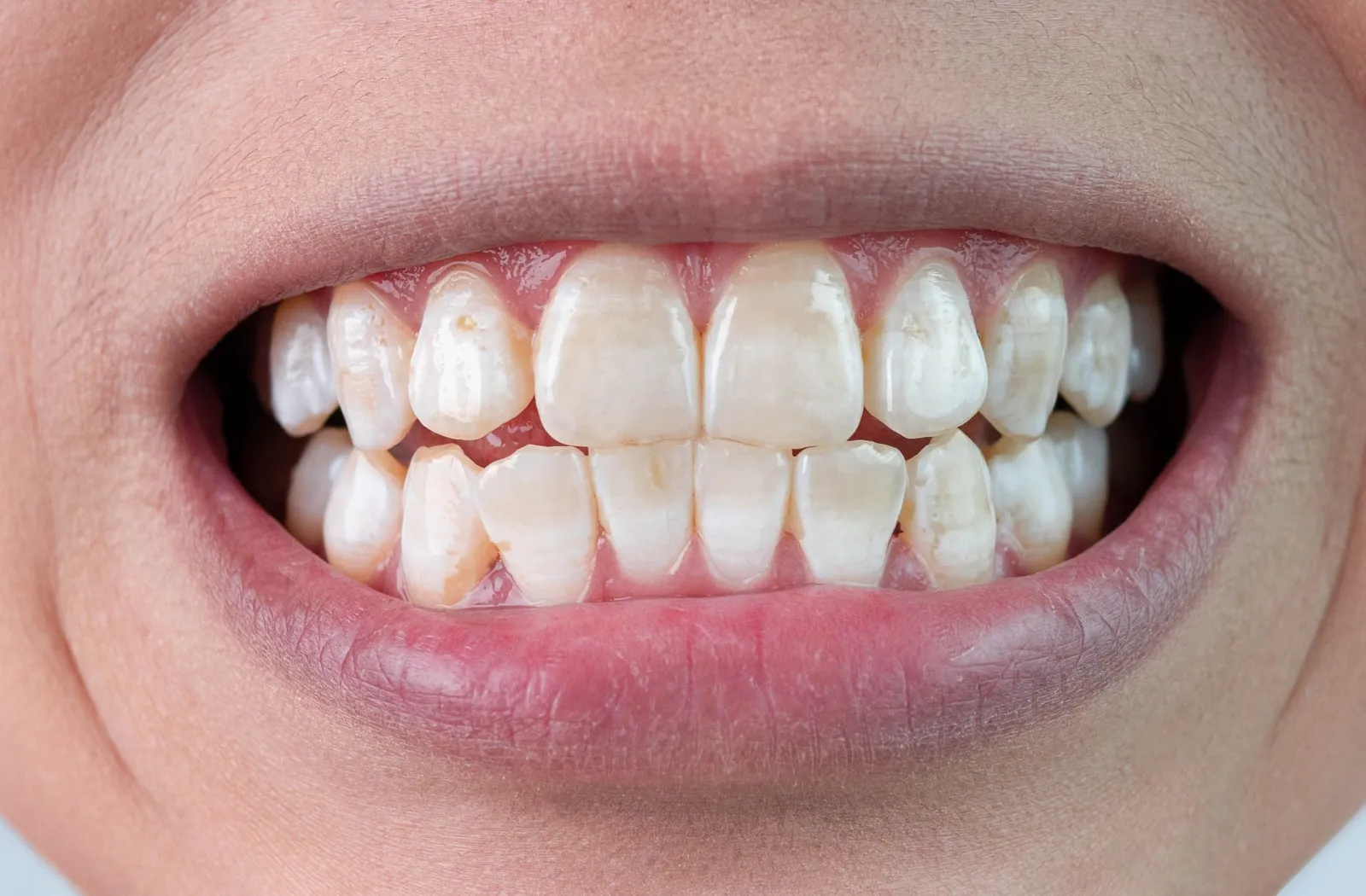 29845 fluorosis teeth
