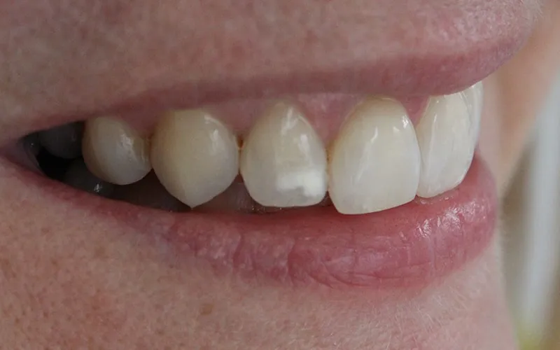 29845 microabrasion teeth