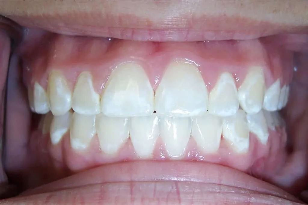29845 white spots teeth whitening