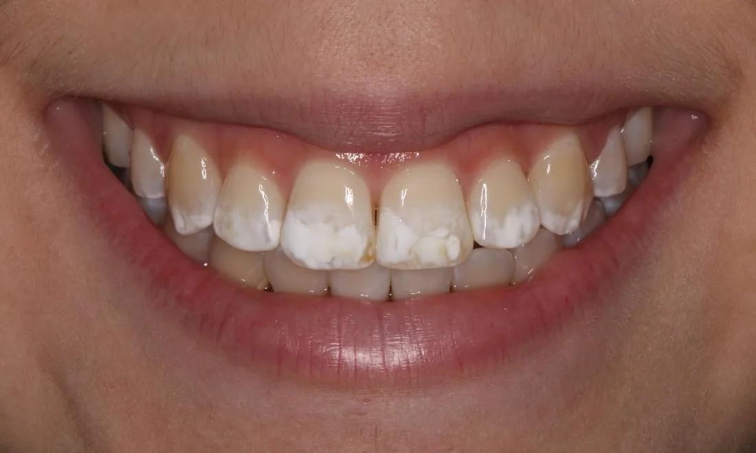 29845 whitening technique