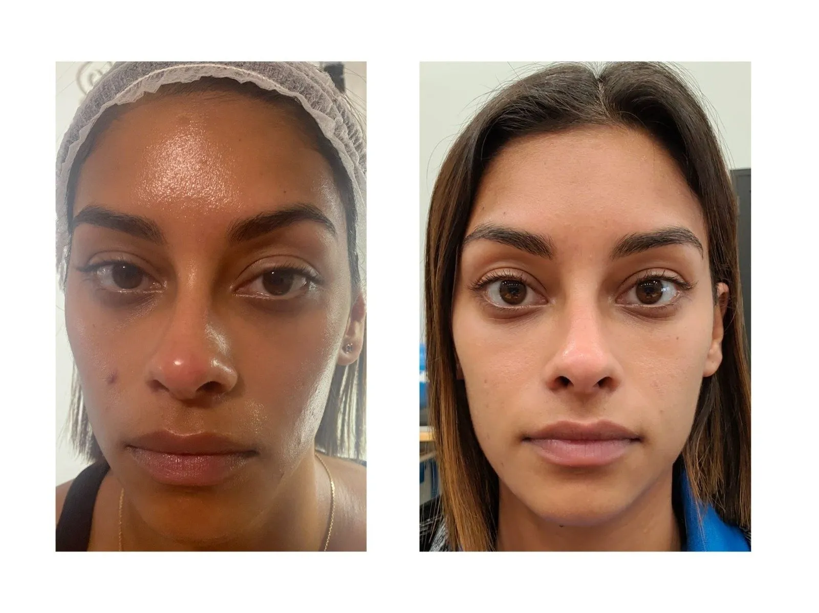 29849 whitening injection near me results