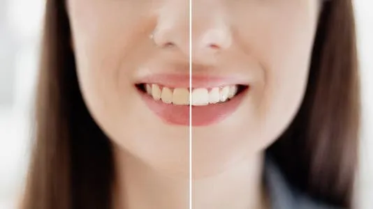 29850 teeth whitening insurance cover 4