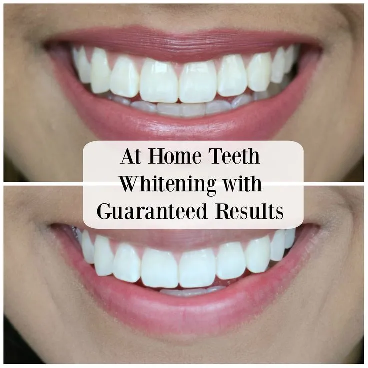 /img/29850-teeth-whitening-insurance-cover-7.webp