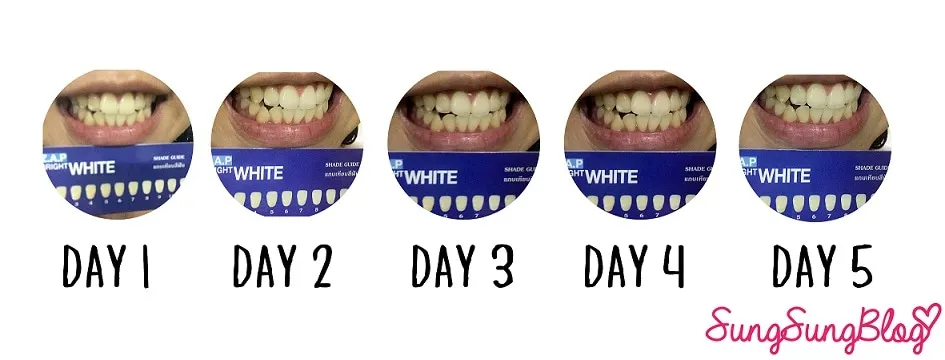 29851 teeth whitening before after